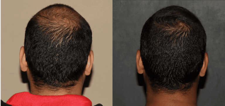 Crown hair transplant before and after