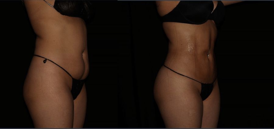 Fat loose before and after Smart Lipo procedure