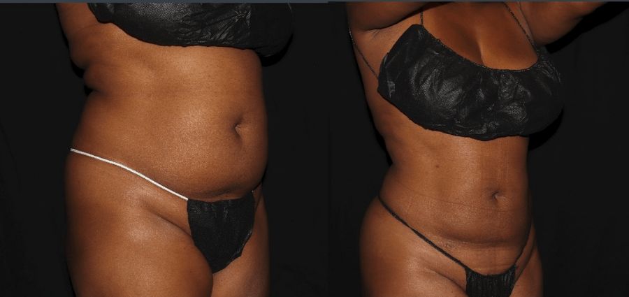 Fat loose before and after Smart Lipo procedure