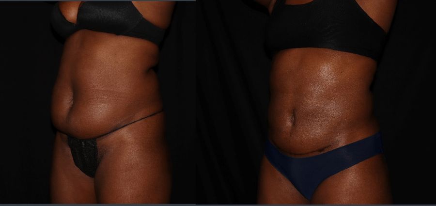 Fat loose before and after Smart Lipo procedure