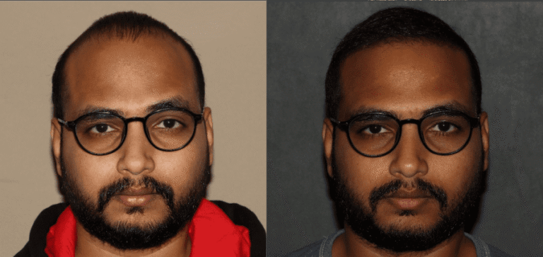 Front hairline before and after