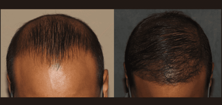Front hairline hair transplant after 9 month