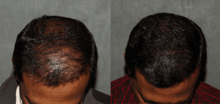 FUE Hair Transplant Philadelphia Before and After