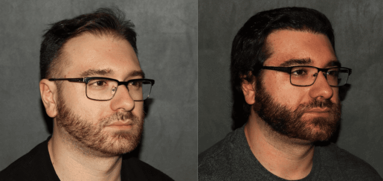 Hair Restoration Philadelphia Before and After