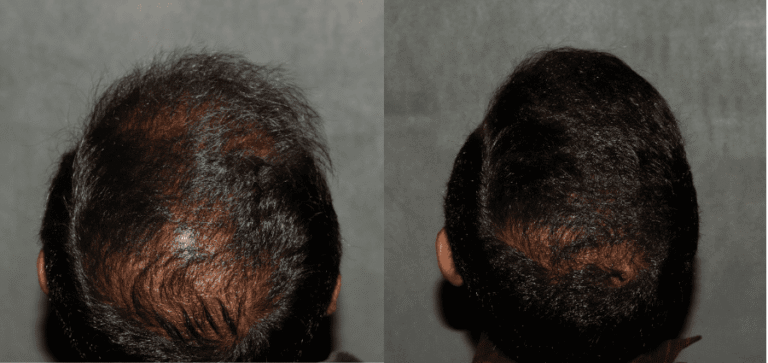 Hair Transplant Before & After