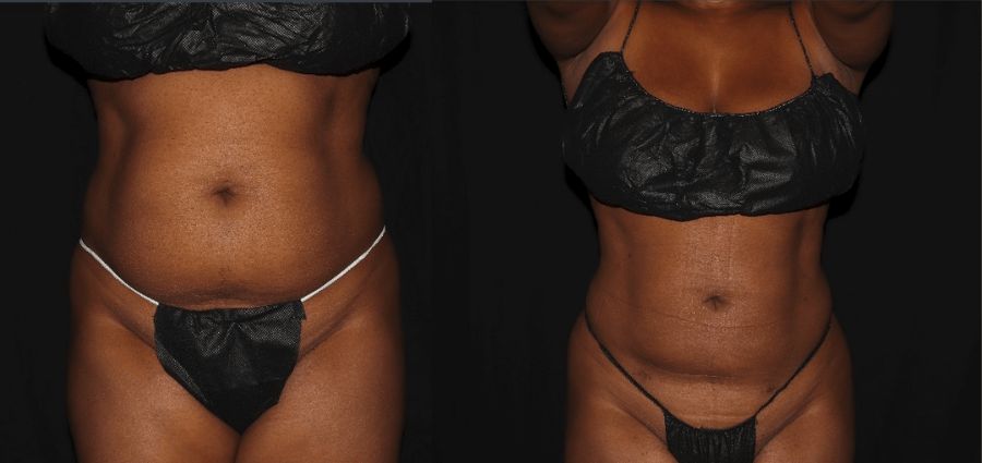Liposuction Before and After