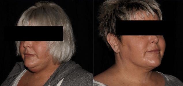 Lumen Tight Before & After