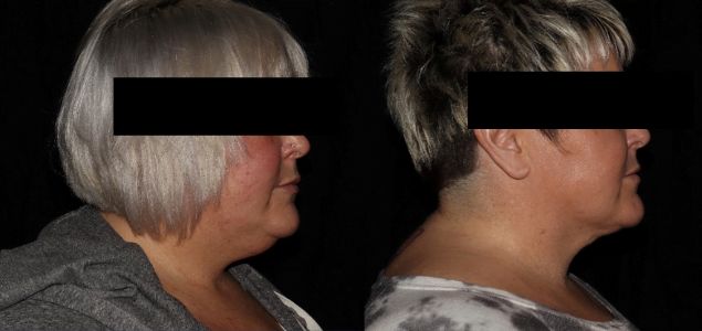 Lumen Tight Before & After