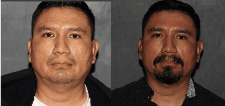 Mustache hair transplant after 5 month
