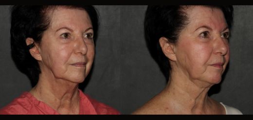 MyEllevate Neck Lift Before & After Neck Lift Philadelphia