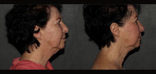 MyEllevate Neck Lift Before & After Philadelphia