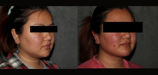 MyEllevate Neck Lift Before & After Philadelphia Jawline Contouring