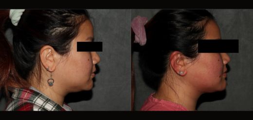 MyEllevate Neck Lift Before & After Philadelphia Jawline Contouring