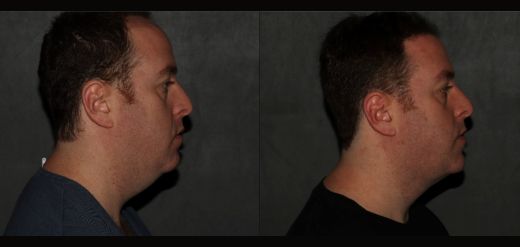 MyEllevate Neck Lift Before & After Philadelphia