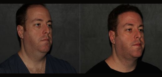 MyEllevate Neck Lift Before & After Philadelphia