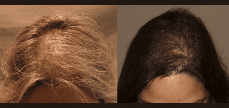 PRP hair restoration treatment before and after