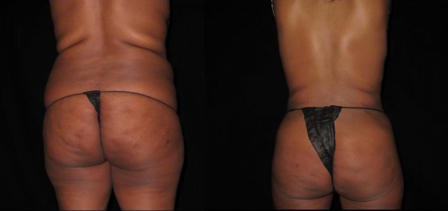 SmartLipo 360 Before & After