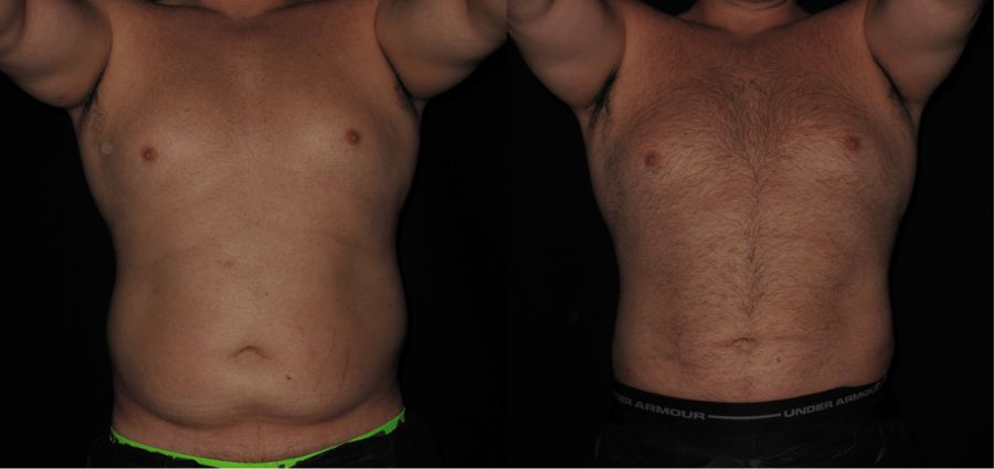 SmartLipo Before & After Abdomen & Flanks