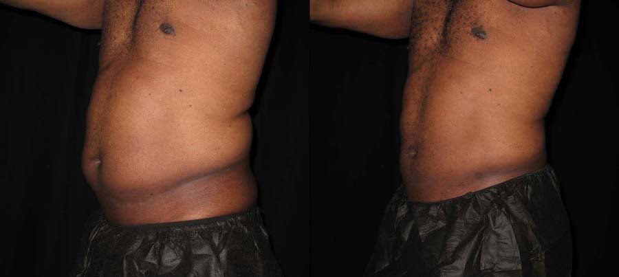 SmartLipo Before & After (Abdomen)