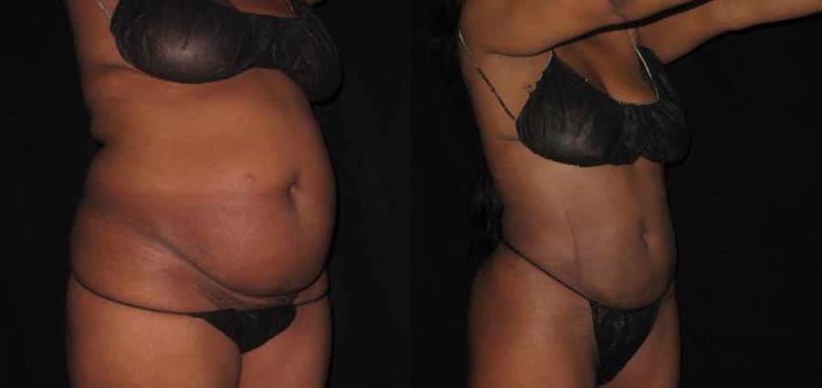 SmartLipo process after image