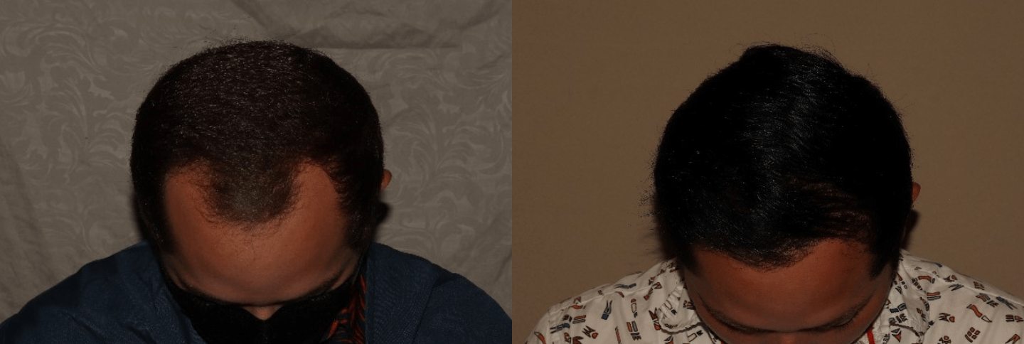 Top Hair Transplant Myths Debunked