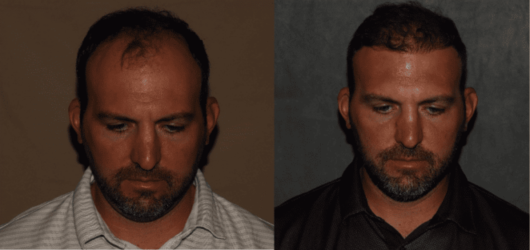 Treat receding hairline hair transplant before and after