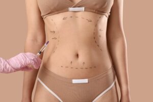 What is Lipo 360?