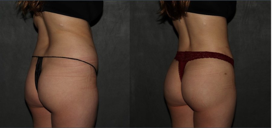 liposuction BBL Philadelphia before and after