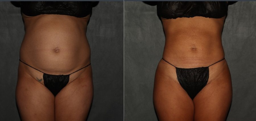 liposuction Philadelphia after process