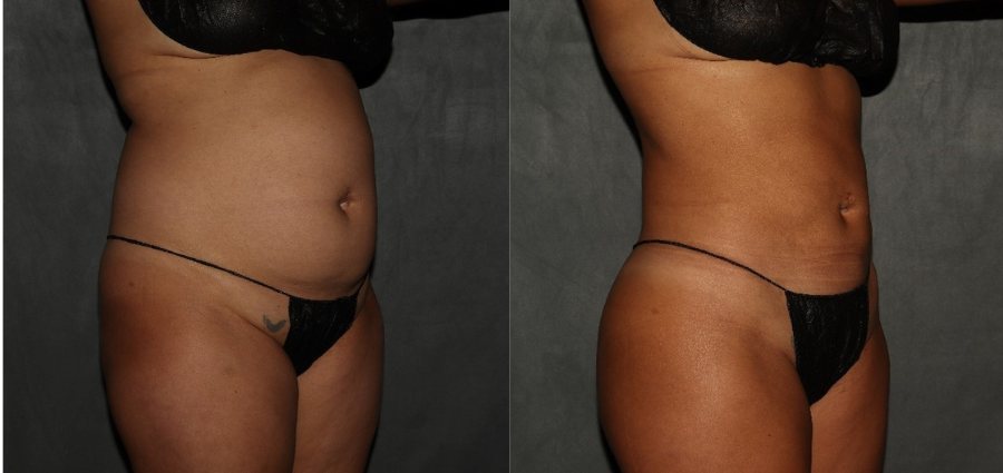 liposuction Philadelphia before and after