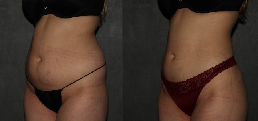 liposuction Philadelphia before and after
