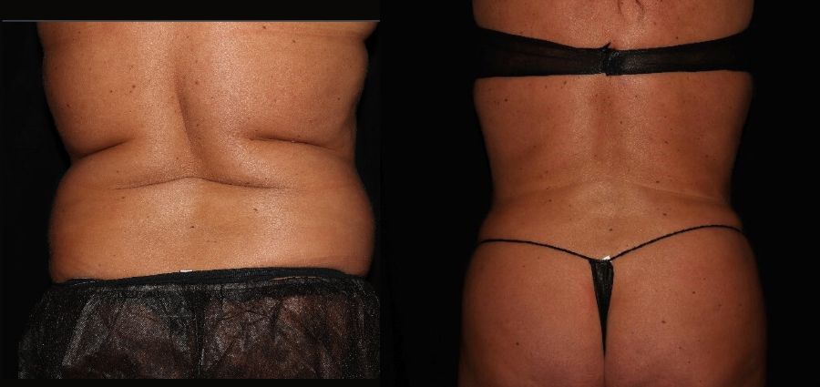 smartlipo after process