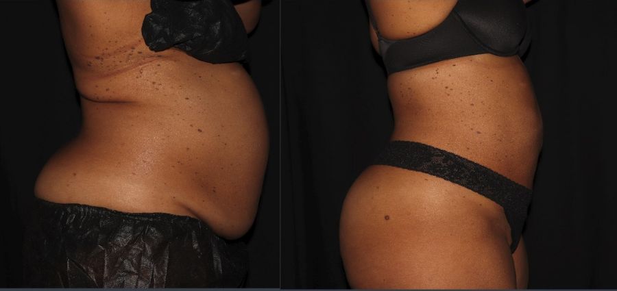 smartlipo image after process