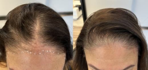 Female Scalp micropigmentation