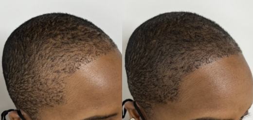 Female Scalp micropigmentation