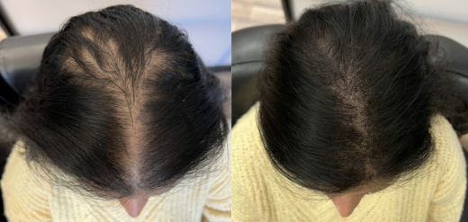 Female Scalp micropigmentation