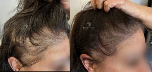 Female Scalp micropigmentation