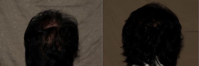 Hair Transplant Philadelphia Before and After