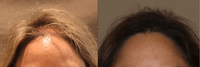 PRP hair restoration before and after for women