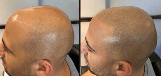 Scalp micropigmentation in PA