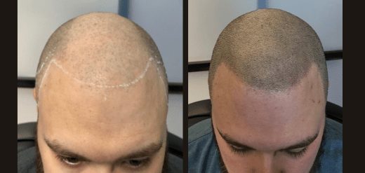 Scalp micropigmentation in PA