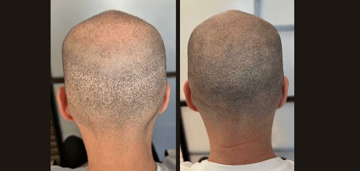Scalp micropigmentation in PA