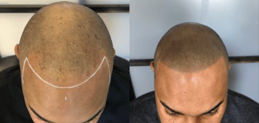 Scalp micropigmentation in Pilly, PA