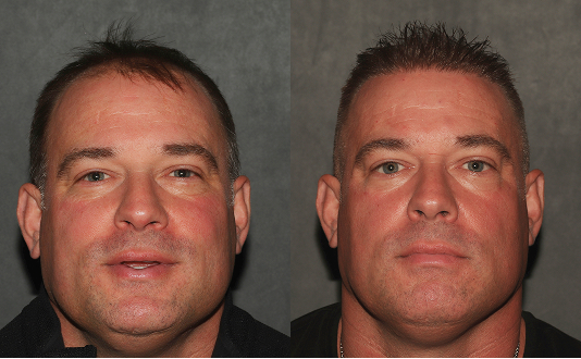 BA Hair Resoration 0102