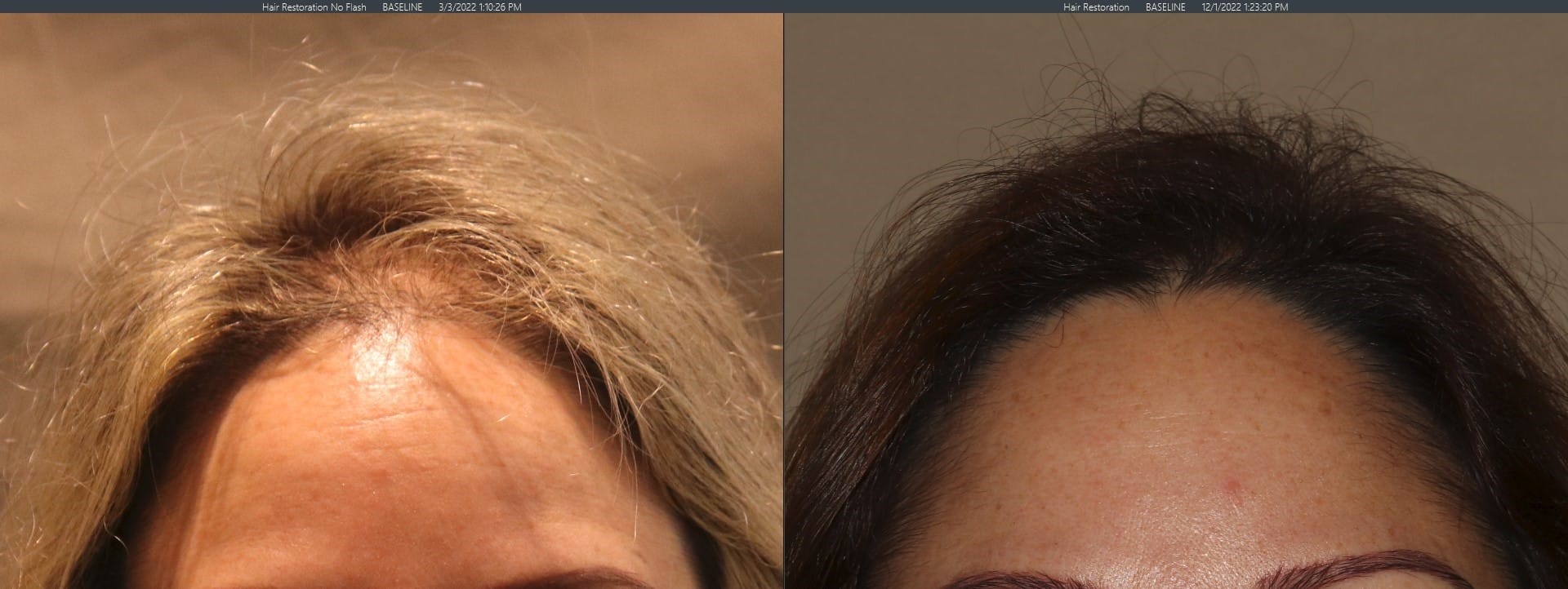 9 month post op PRP female 1