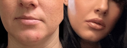 Lipo Filler BA 1