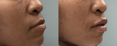 Lipo Filler BA 3